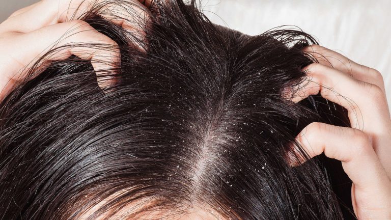 Top 3 dầu gội trị ngứa da đầu tốt nhất 