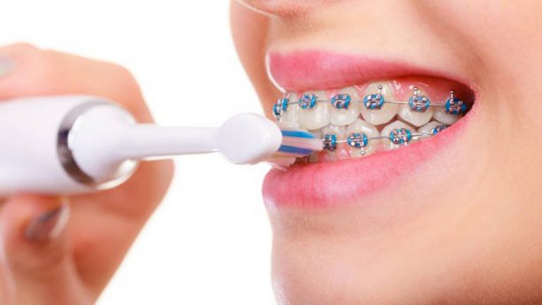 Bàn chải điện cho người niềng răng loại nào tốt?