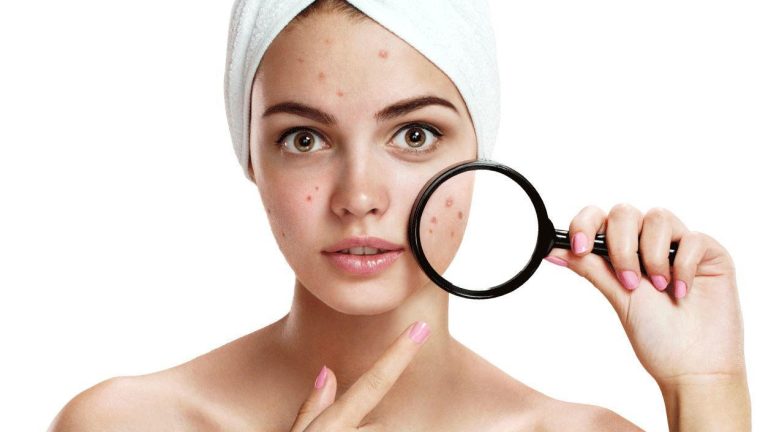 Mụn nội tiết là gì? Bị mụn nội tiết uống gì nhanh hết?