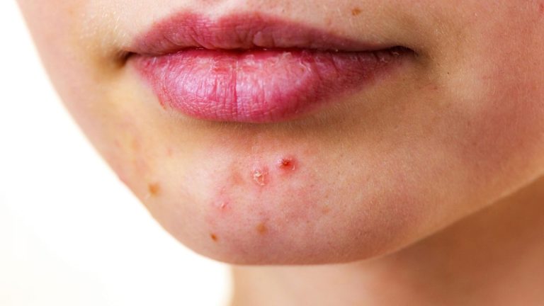 Mụn nội tiết có thể trị dứt điểm không? Mách chị em bí quyết chăm sóc da bị mụn nội tiết sạch đẹp
