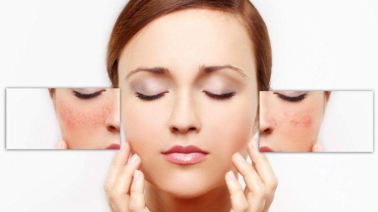 Những điều cần biết về dị ứng mỹ phẩm và cách phòng tránh