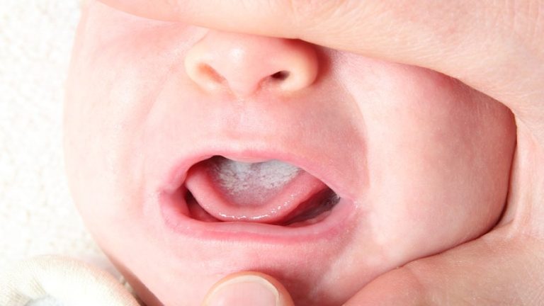 Dung dịch rơ lưỡi là gì? Top 3 dung dịch rơ lưỡi an toàn cho trẻ sơ sinh